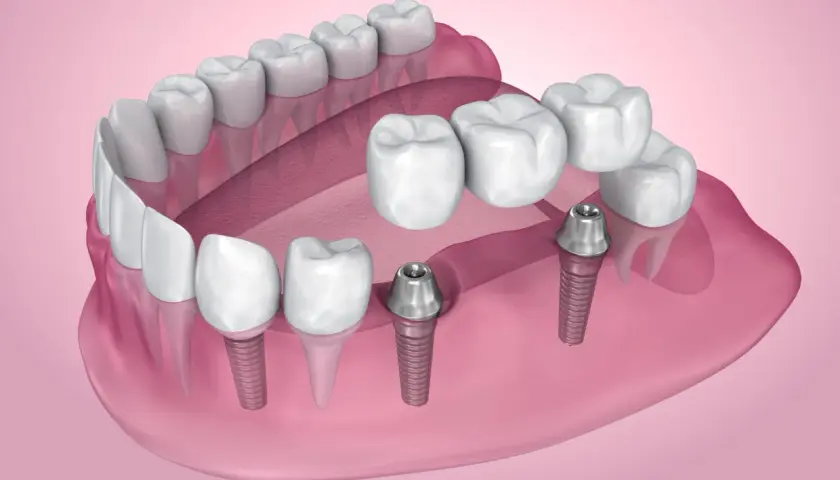 Nowoczesne mosty zębowe na implantach, przywracające pełny uśmiech.