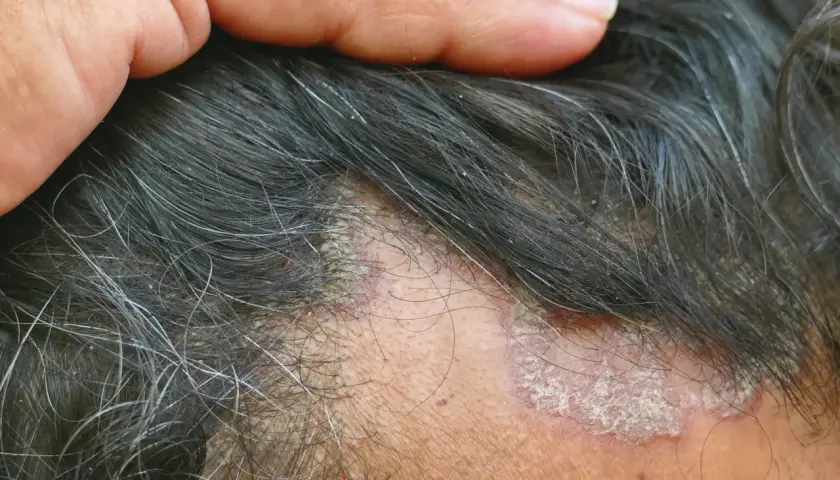 Schuppen im Haar: Ursachen, Behandlung & Hausmittel für gesunde Kopfhaut