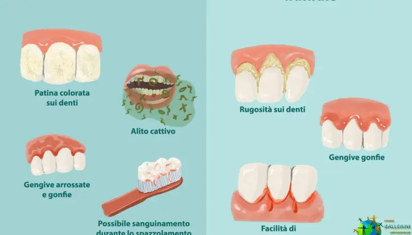 Illustrazione che mostra la differenza tra placca e tartaro: la placca causa patina, alito cattivo e gengive gonfie; il tartaro provoca rugosità, gengive gonfie e sanguinamento.