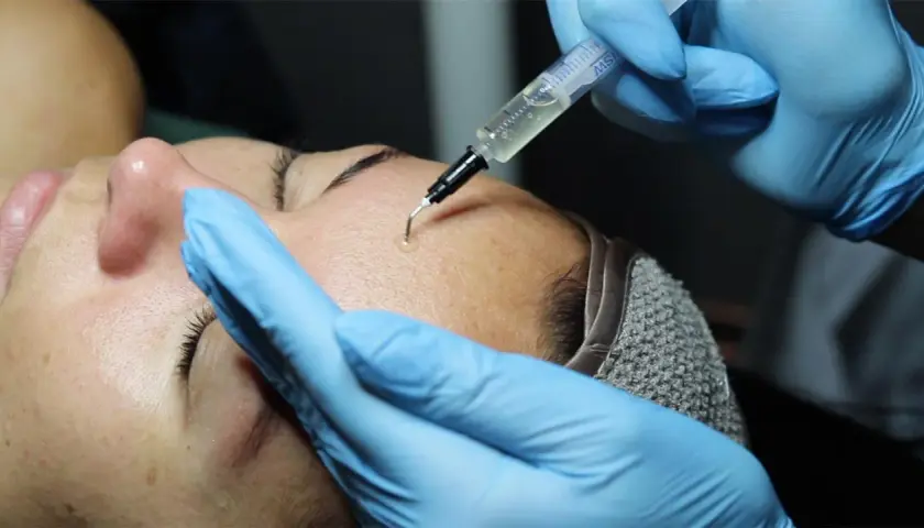 Close-up of a person receiving a PRX-T33 facial treatment with a syringe applying solution to the forehead.