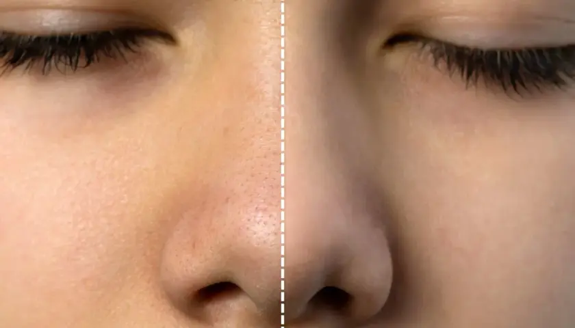 Före och efter-bild som visar hur laserbehandling minskar synligheten av stora porer på huden.