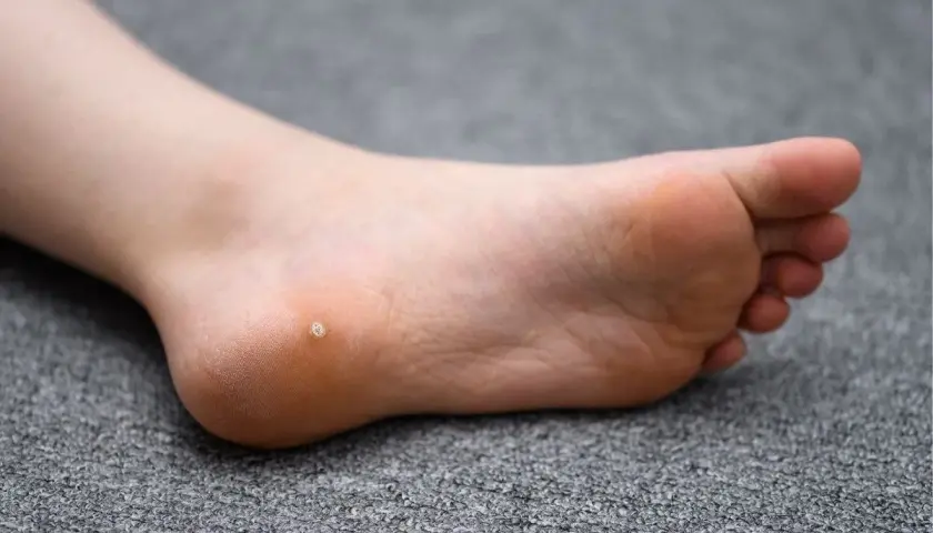 Piede di un bambino con una piccola verruca sul tallone.