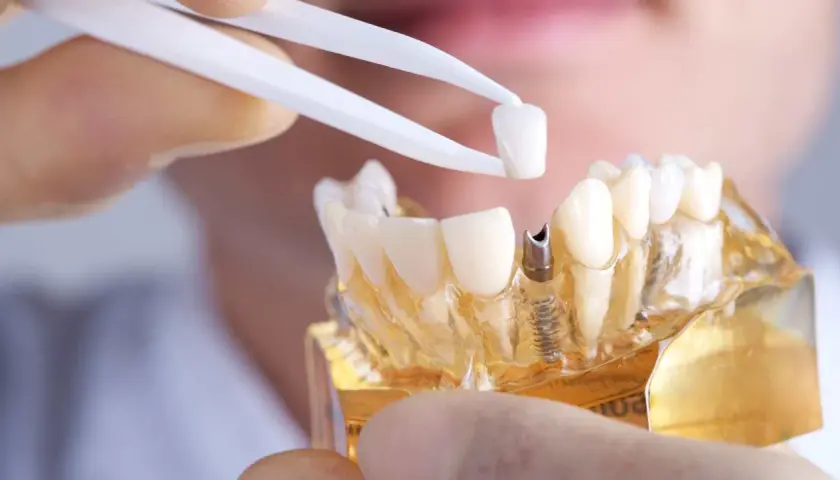 Modello di protesi dentale in zirconio, con pinzette che tengono una corona. Valutazione dei denti in zirconio: pro e contro.