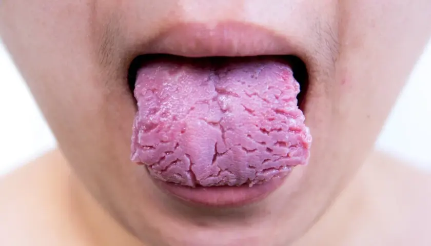 Lengua rosada con aspecto agrietado, como si tuviera una herida, sobresale de unos labios.