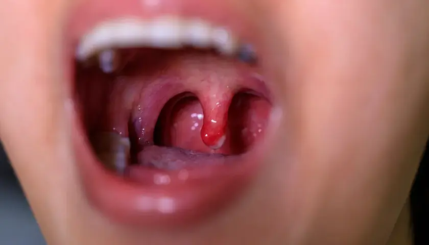 Gola arrossata con tonsille gonfie e una piccola lesione, indicativa di mucosite orale.