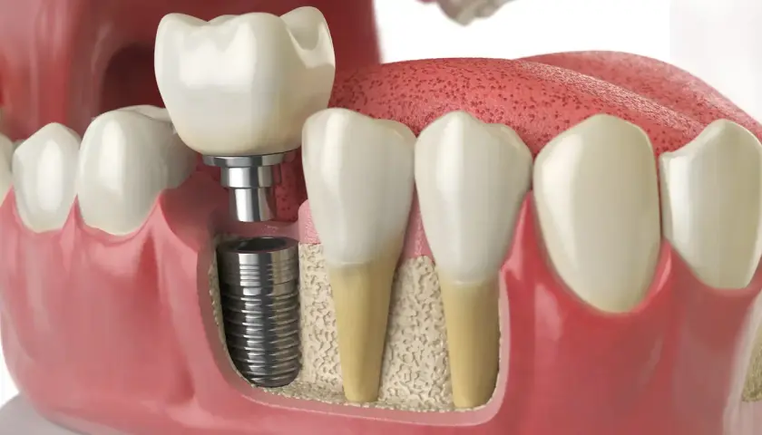 Immagine 3D di un impianto dentale inserito nell'osso, con una corona in cima. Si vedono anche denti naturali e gengive. Informazioni su innesto osseo dentale effetti collaterali.