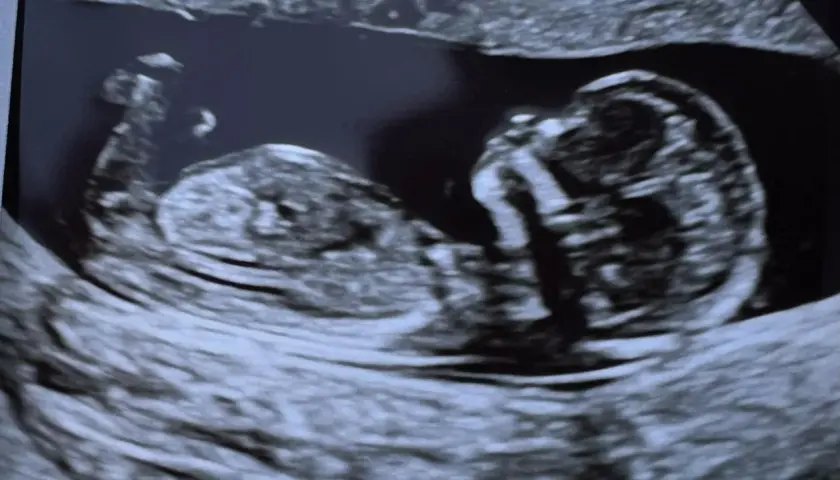 Ecografia 14 settimane: profilo del feto, testa e corpo visibili. Si attende di scoprire se è maschio o femmina.