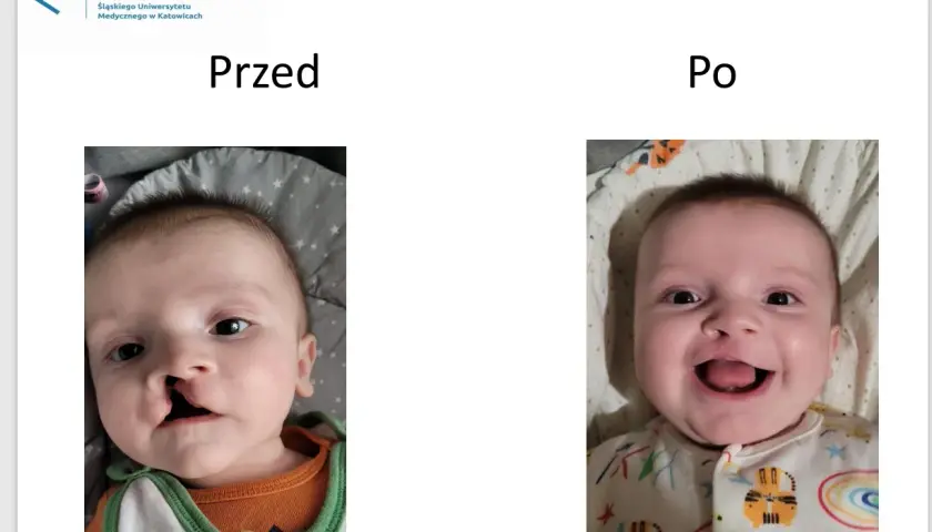 Uśmiechnięty chłopiec po korekcie zajęczej wargi. Po lewej widać szew, po prawej uśmiech.