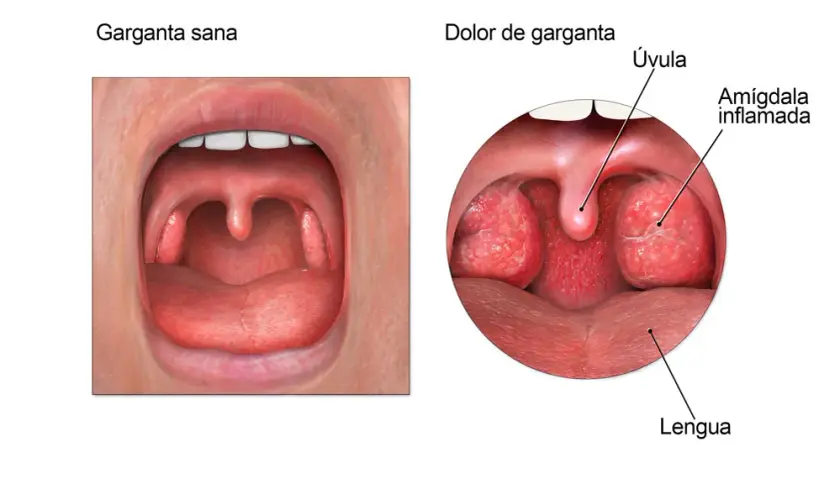 Medicamentos para el dolor de garganta: alivia el malestar rápidamente