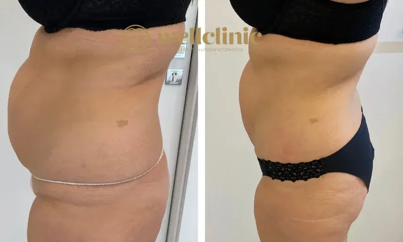 Liposukcja: Modelowanie sylwetki czy to rozwiązanie dla Ciebie?
