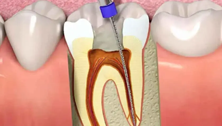 Procedimiento dental: un instrumento limpia el nervio de una muela al aire, mostrando el interior del diente.