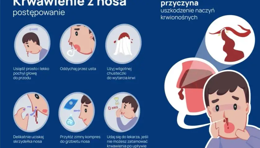 Krwawienie z nosa przyczyny: najczęstsze powody i co z nimi zrobić.