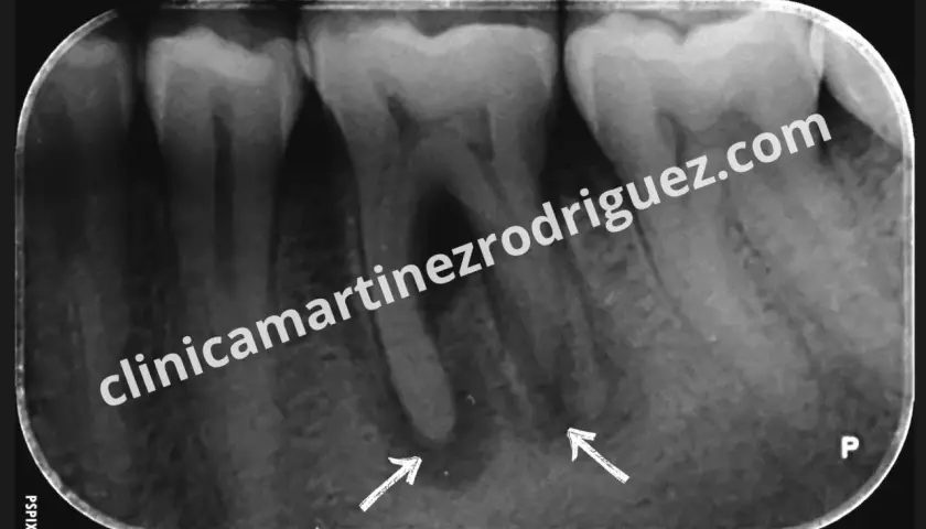 Radiografía dental muestra una posible infección endodoncia con áreas radiolúcidas en ápices radiculares, señaladas por flechas.