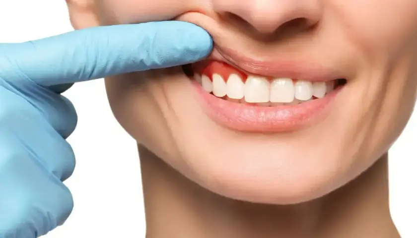 Ból zęba? Czerwone, opuchnięte dziąsła mogą wymagać antybiotyku na zęba. Dentysta bada dziąsła.