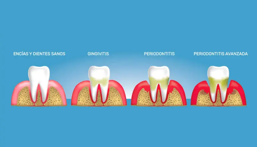Ilustración muestra la progresión de la gingivitis a periodontitis, con encías y dientes sanos, gingivitis, periodontitis y periodontitis avanzada.