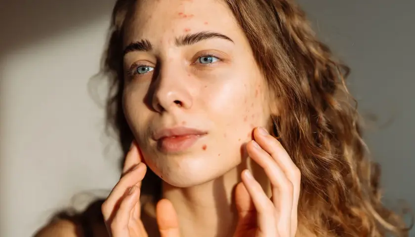 Junge Frau mit Akne im Gesicht, die sich besorgt die Wangen berührt. Mögliche isotretinoin nebenwirkungen.