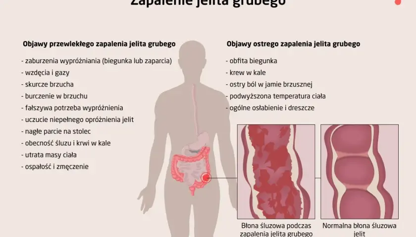 Ilustracja przedstawia objawy zapalenia jelita grubego, w tym bóle brzucha, biegunkę, krew w kale i osłabienie. Pokazuje też porównanie błony śluzowej jelita zdrowego i zmienionej zapalnie.