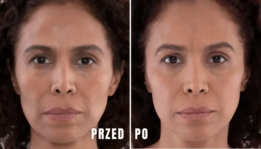 Przed i po zabiegu z użyciem kwasu polimlekowego pod oczy. Skóra wokół oczu jest gładsza, cienie zredukowane.