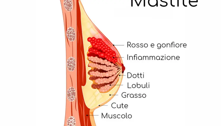 Illustrazione anatomica del seno che mostra infiammazione e rossore, sintomi comuni di dolore al seno durante l'allattamento.