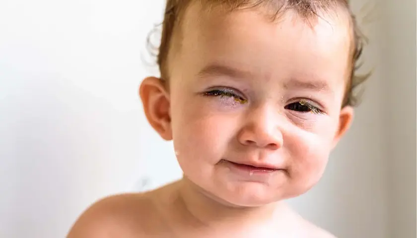 Ein Baby mit einem geschwollenen Augenlid einseitig. Gelbliche Verkrustungen am Auge. Hausmittel könnten helfen.