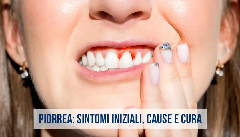 Gengive sanguinanti, un sintomo iniziale della piorrea. Scopri le cause e come curarla.