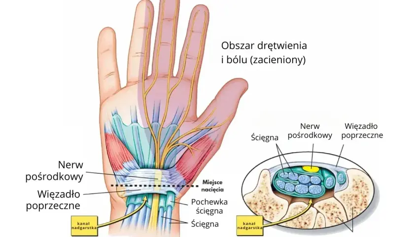 Anatomia dłoni z zaznaczonym nerwem pośrodkowym i więzadłem poprzecznym. Widoczny kanał nadgarstka, kości nadgarstka i obszar drętwienia.