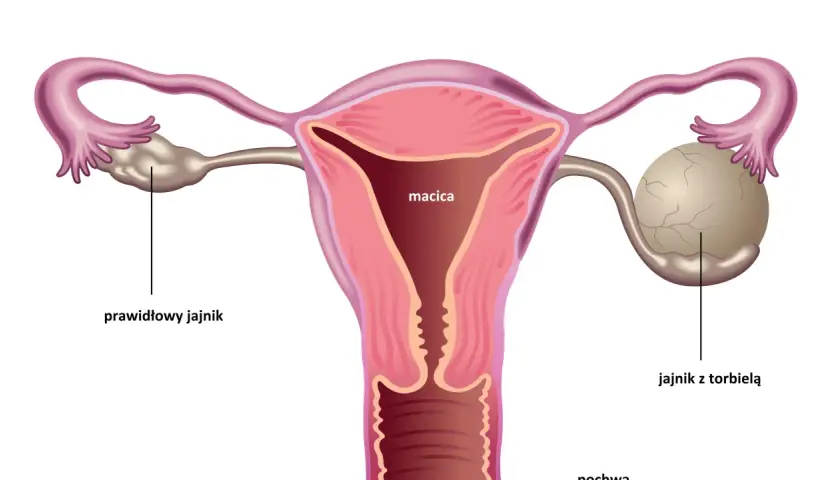 Anatomia kobieca: macica, jajowody, jajnik prawidłowy i jajnik z torbielą.
