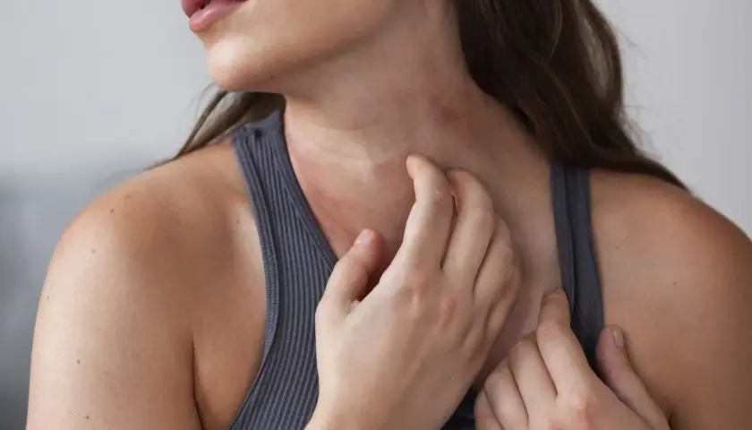 Una mujer se rasca el cuello, mostrando un sarpullido rojo e irritado.