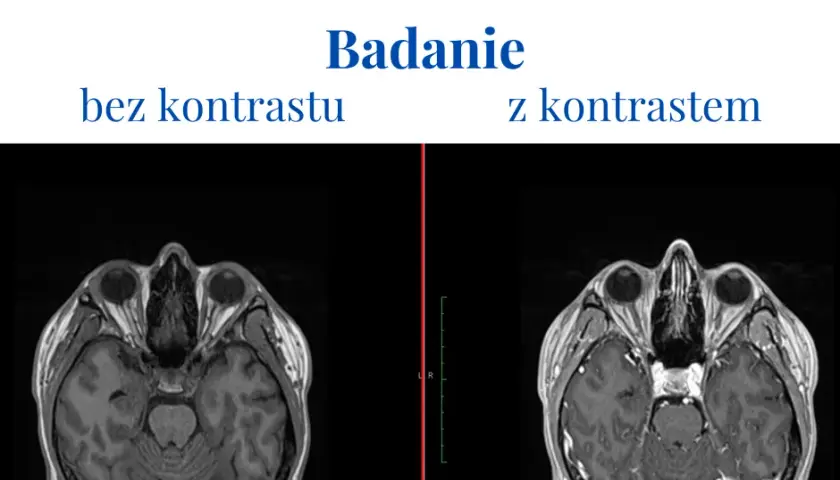 Skutki uboczne po podaniu kontrastu tomografii - co warto wiedzieć?