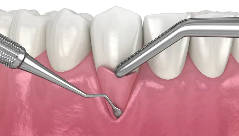 Instrumentos dentales trabajan en la encía, mostrando cómo las encías se regeneran para una sonrisa saludable.