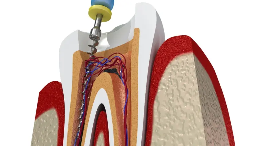 Instrumento dental limpia conducto radicular afectado por caries avanzada. Se aprecian vasos sanguíneos y nervios.