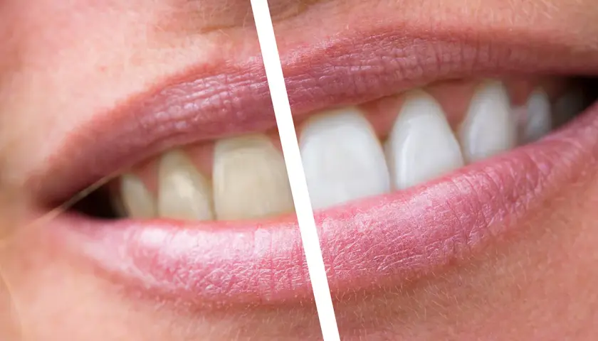 Prima e dopo: denti ingialliti e con placche, poi bianchi e splendenti. Un sorriso trasformato.