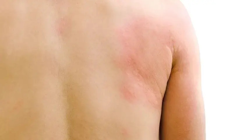 Objawy tocznia rumieniowatego: poznaj pierwsze niepokojące symptomy choroby