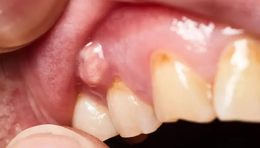 Gengiva gonfia con una piccola protuberanza, possibile fistola gengivale su dente incapsulato.