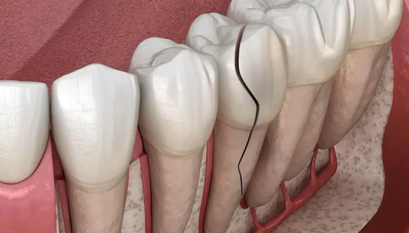 Dente con evidente crepe smalto, che si estende dalla corona alla radice, mostrando la vulnerabilità della struttura dentale.