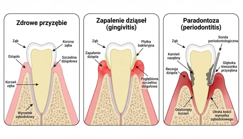 Ilustracja pokazuje postępujące problemy z dziąsłami: od zdrowych, przez zapalenie, aż po paradontozę, gdzie pojawia się ból dziąsła między zębami i utrata kości.