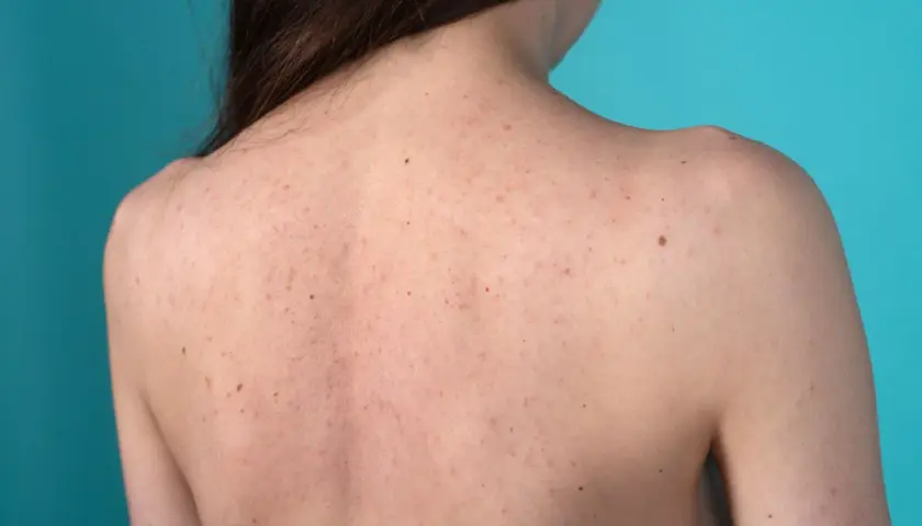 Schiena di una persona con inestetismi cutanei, tra cui brufoli e nei, su sfondo blu.