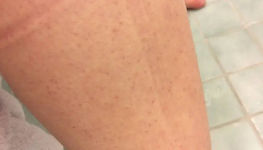 Närbild på hud med små prickar, liknande jordgubbsben. En bit av en vit handduk syns i bakgrunden.