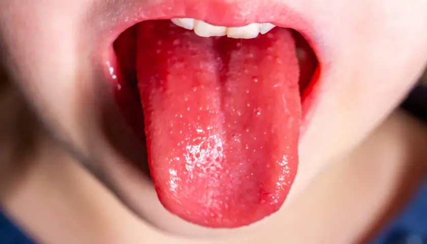 Langue rouge et gonflée, recouverte de petits points rouges. Symptôme possible du temps incubation scarlatine.
