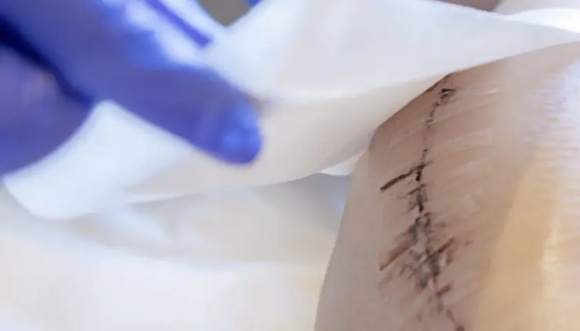 Ręka w niebieskiej rękawiczce delikatnie dotyka opatrunku na skórze, ukazując ślady po zabiegu, które mogą sugerować martwicę po lipolizie.