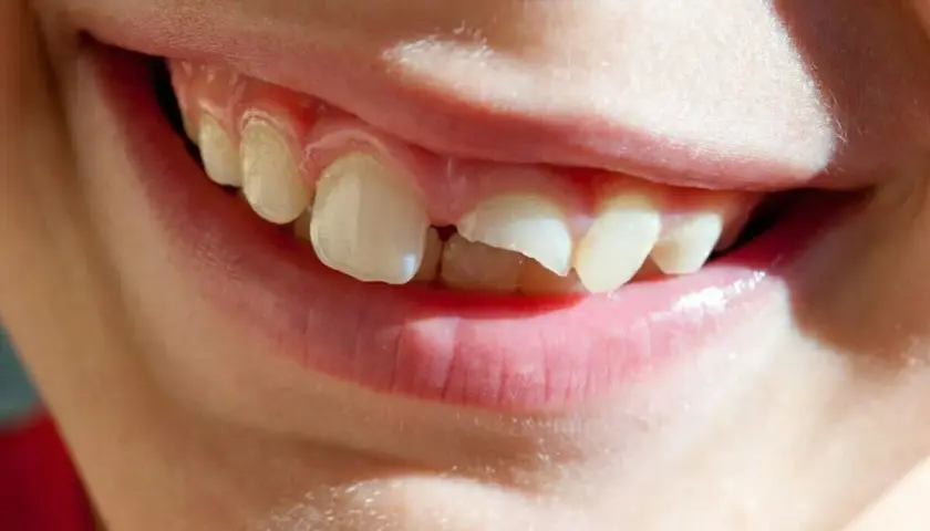¡Ay, se me ha caído un diente! ¿Qué hago? La sonrisa de un niño con un diente roto y un espacio vacío.
