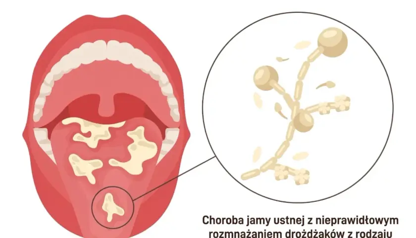 Ilustracja przedstawia jamę ustną z białymi nalotami na języku i podniebieniu, objawy grzybicy jamy ustnej. Powiększony fragment ukazuje drożdżaki Candida albicans.