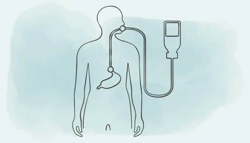Stilisierte Darstellung eines Körpers mit Magensonde und Infusionsbeutel. Die Frage "wie lange kann man mit einer Magensonde leben" wird visuell thematisiert.