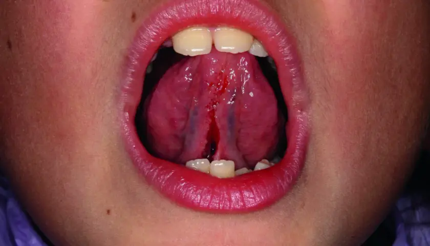 Bocca aperta con lingua che mostra un frenulo linguale corto e lacerato, con sanguinamento.