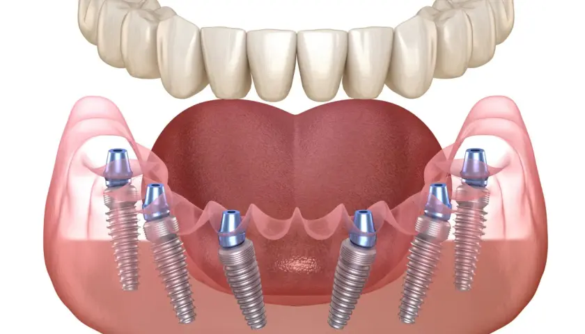 Implantes dentales en la mandíbula inferior, mostrando la integración del injerto óseo dental. Problemas de encía y hueso pueden afectar la estabilidad.