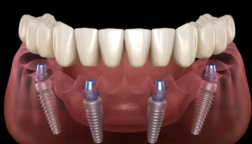Arcata dentale fissa su quattro impianti dentali, una soluzione moderna per un sorriso completo.