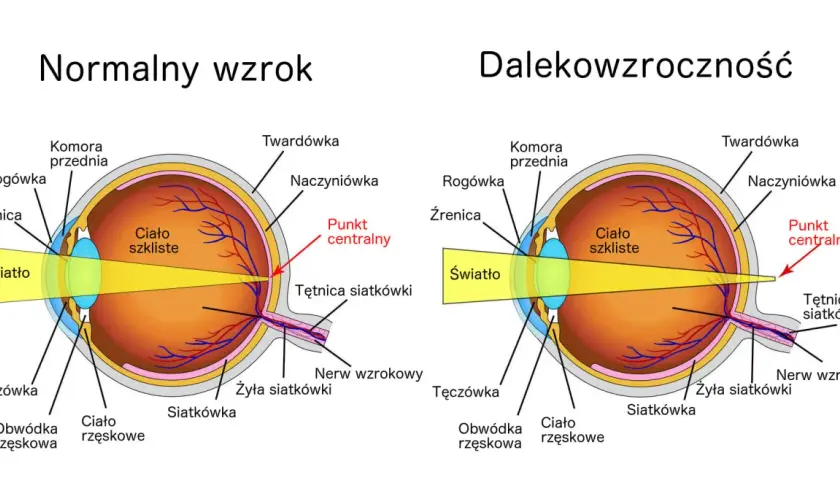 Porównanie oka z normalnym wzrokiem i dalekowzrocznością. Światło skupia się za siatkówką przy dalekowzroczności.