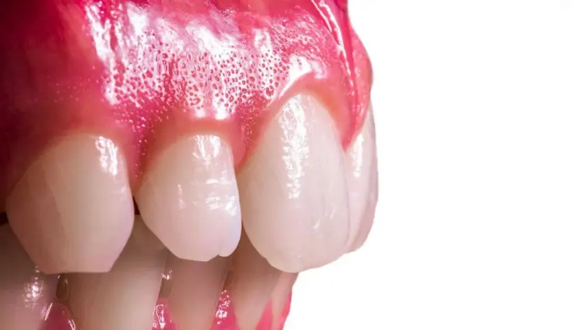 Primer plano de encías inflamadas y dientes, mostrando un posible epulis dental.