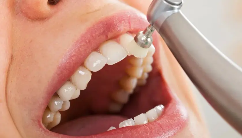 La pulizia dei denti con uno strumento rotante per un sorriso smagliante.