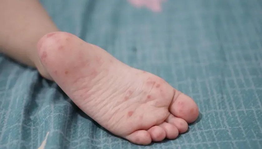 Pied d'enfant avec des éruptions rouges, symptôme de la maladie pieds-mains-bouche chez l'adulte.